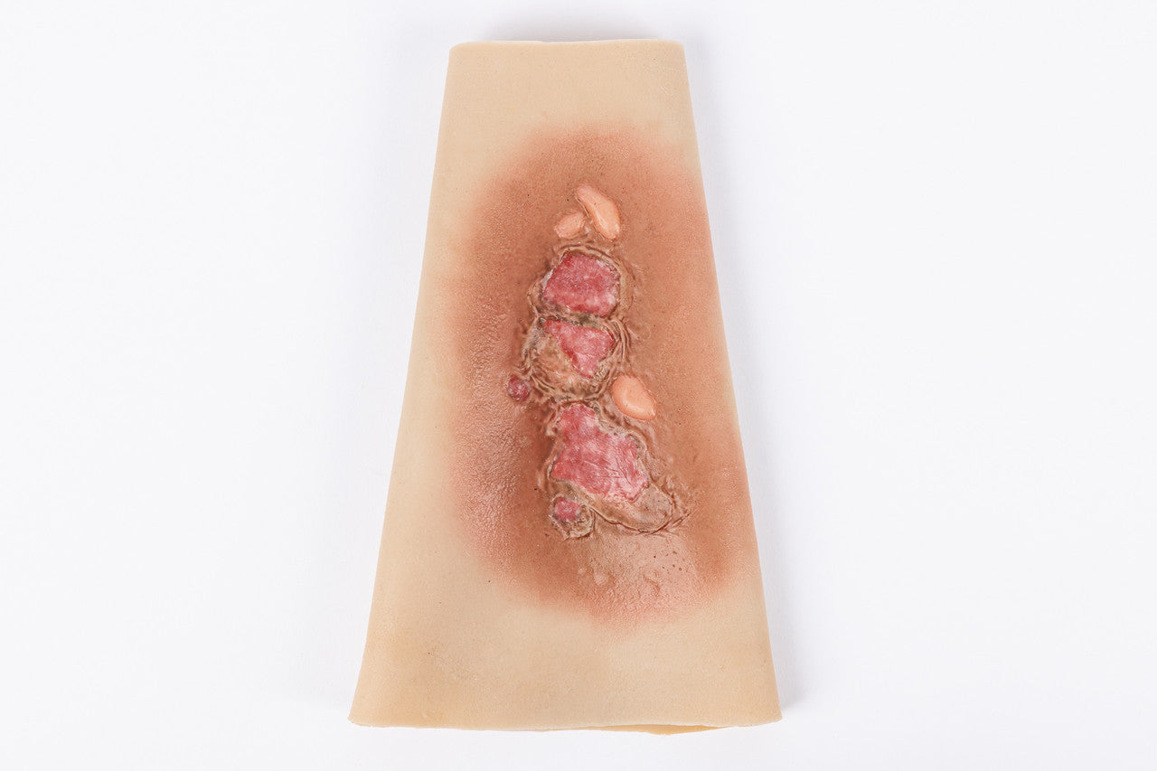 TRAUMASIM Wearable Small Burn Simulation Forearm reusable silicone moulage device showing realistic burn wound presentation worn on forearm for casualty training exercises