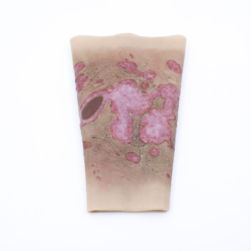 TraumaSim Wearable Large Burn Forearm realistic wearable burn for training scenarios
