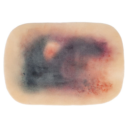 TraumaSim Self-Adhesive Large Haematoma
